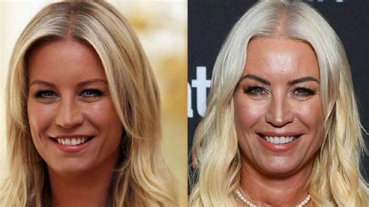 
Denise Van Outen Botox And Facelift Before And After Plastic Surgery 