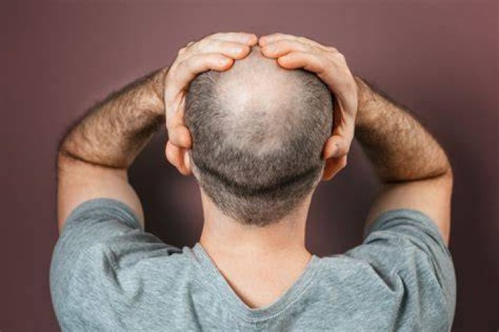 
Does Andi Oliver Has Alopecia? With Hair Pics – Why Is She Bald? 