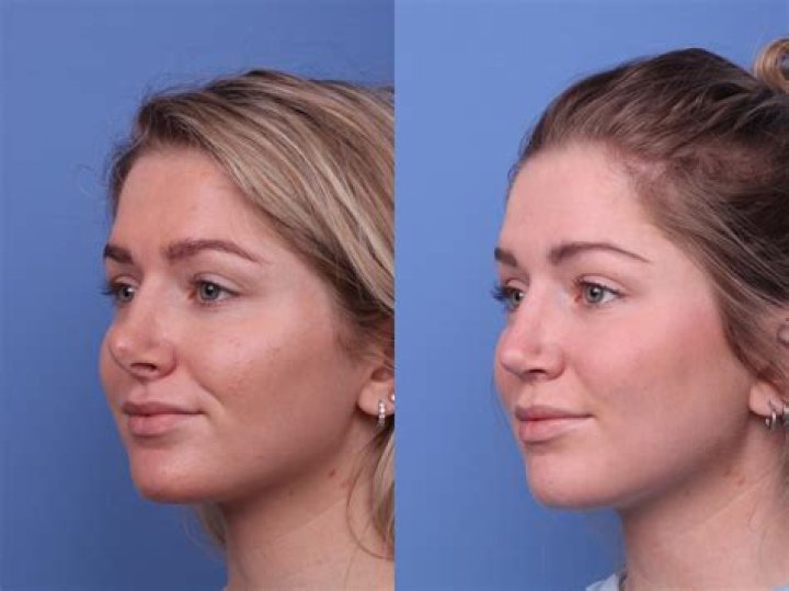 
Emma Booth Plastic Surgery Before And After: Outlast Cast Accident And Health Update 