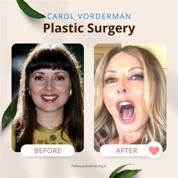 
Has Carol Vorderman Had Plastic Surgery Done On Her? Cosmetic Upgrades Matter Could Not Be Hidden 