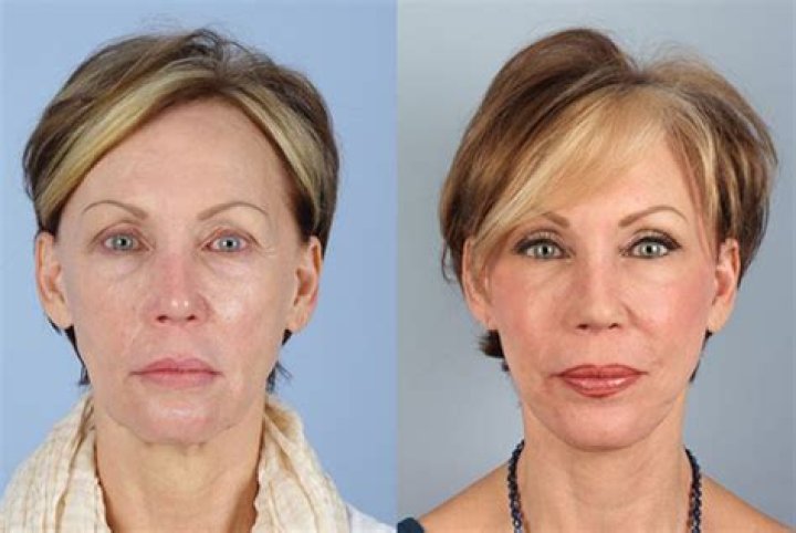 Has Elton John Done Plastic Surgery? Fans Curious About Botox And Facelift!