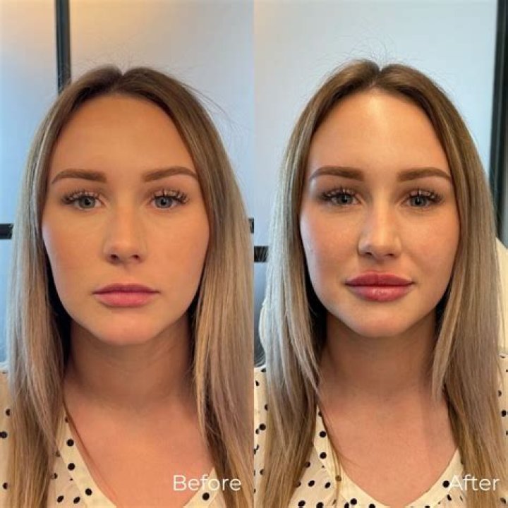 
Helen Skelton Botox And Lip Filler – Before And After Photos Explored! 