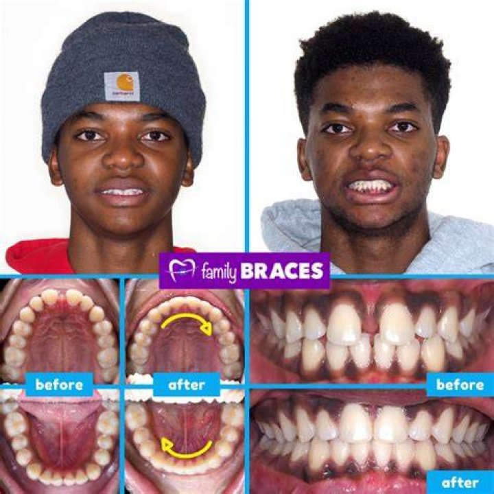 
Shooting Stars Actor Caleb McLaughlin Teeth Before And After: Has He Used Braces And Whitening? 
