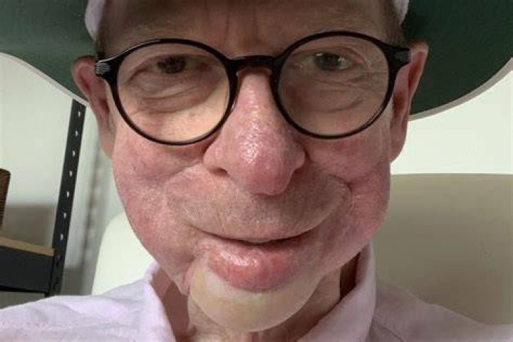 
What Happened To Hey Hey Its Saturday Star John Blackman’s Jaw? Skin Cancer Leading To Surgery 