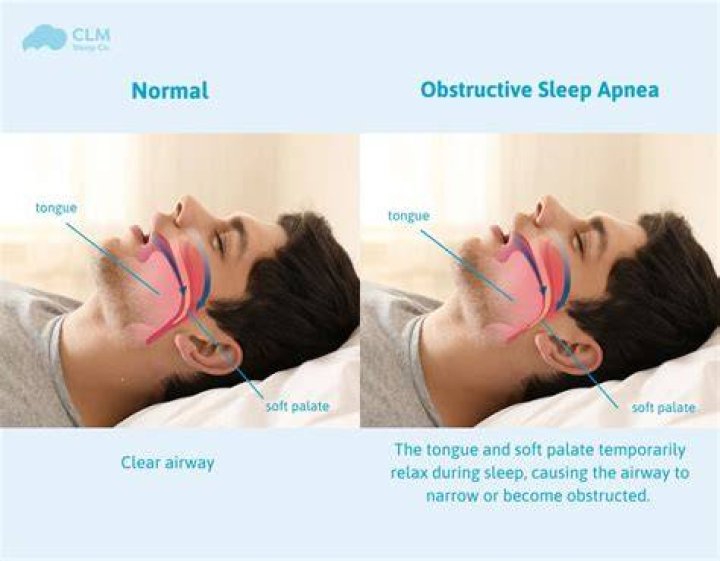 
What Really Happened To Bappi Lahiri Voice? How Is Obstructive Sleep Apnea Caused? 